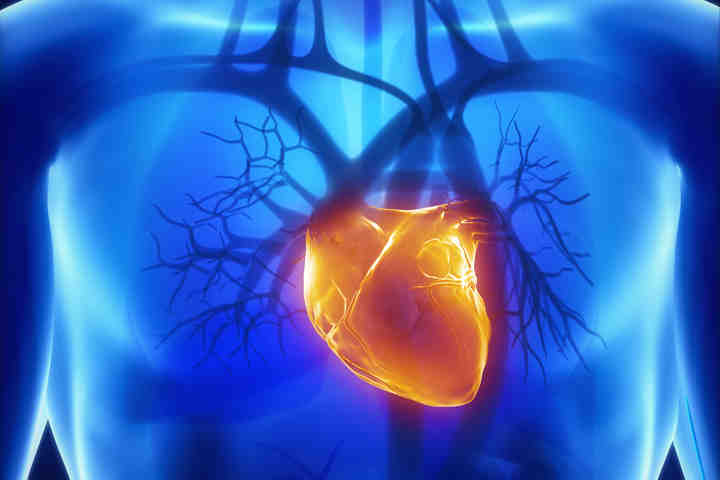 Infarto del miocardio